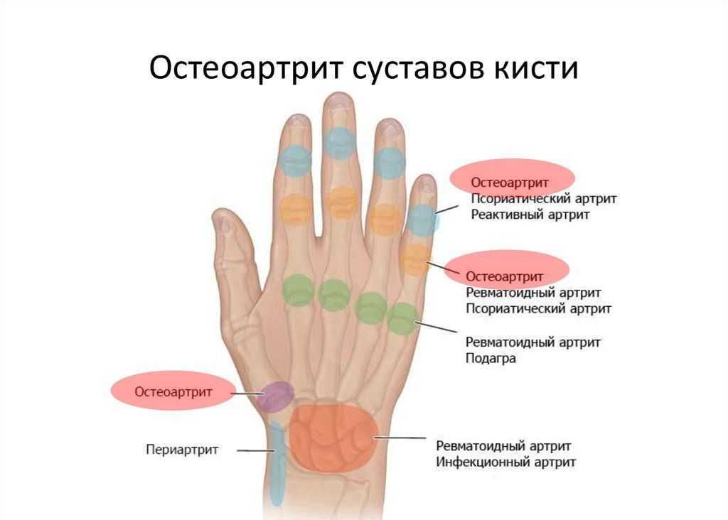 Полинейропатия : симптомы, признаки и причины, диагностика и лечение