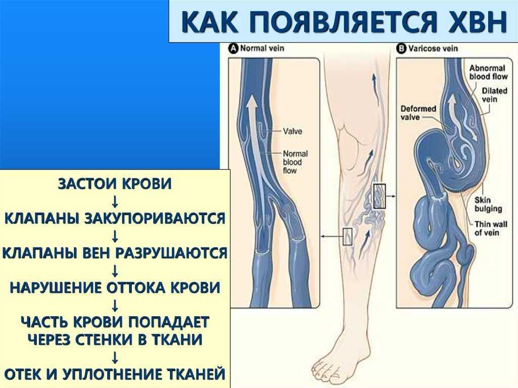 Нарушения венозного кровообращения головного мозга - симптомы болезни, профилактика и лечение нарушений венозного кровообращения головного мозга, причины заболевания и его диагностика на eurolab