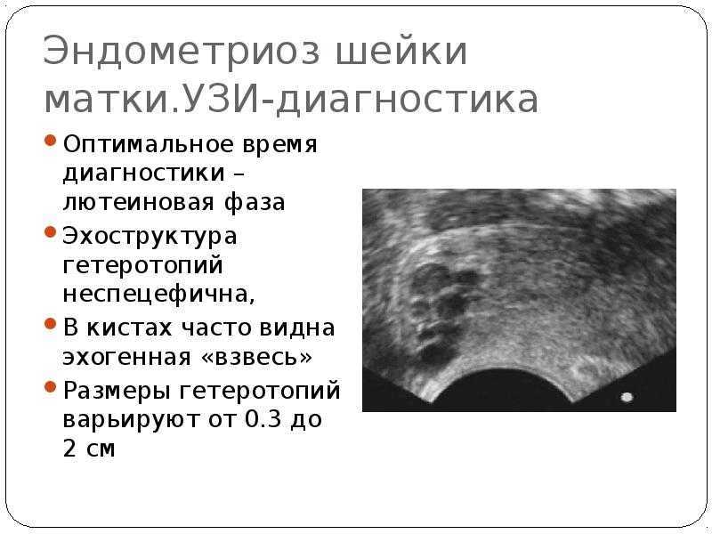 Эндометриоз: что это и как бороться?