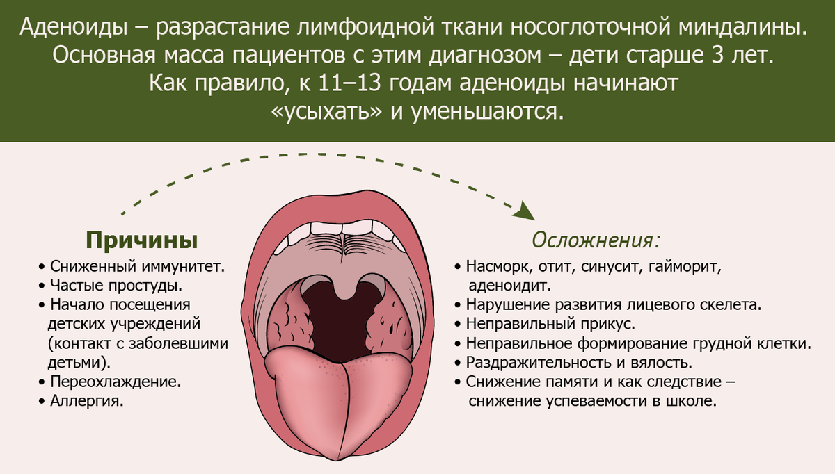 Гипертрофия лимфоидной ткани глотки