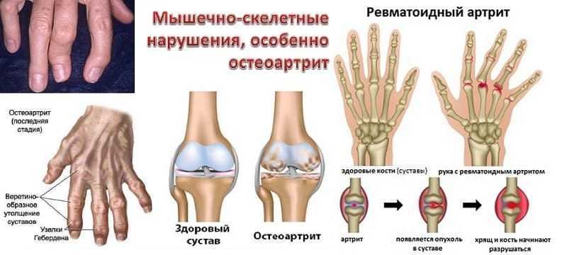 Симптомы артрита голеностопного сустава