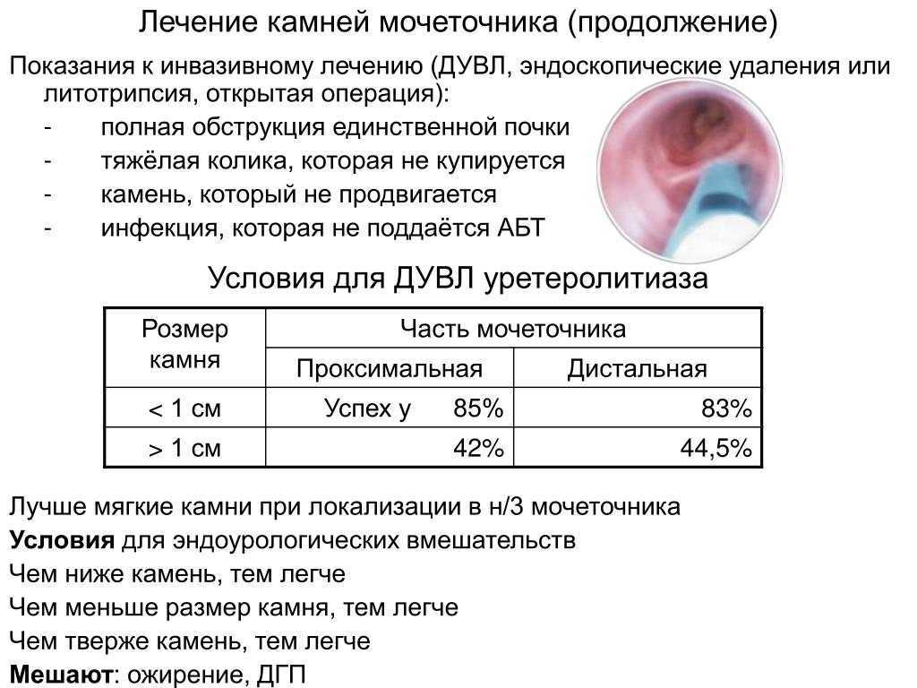 Мочекаменная болезнь (камни в почках, мочеточниках, мочевом пузыре): симптомы, диагностика и обследование, лечение (дробление камней) – урология