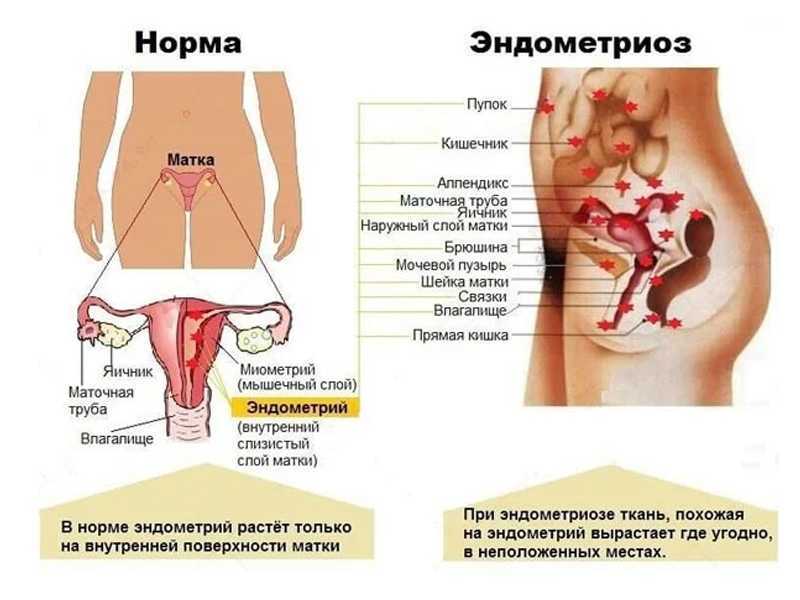 Эндометриоз: как диагностировать и лечить - клиника в уручье