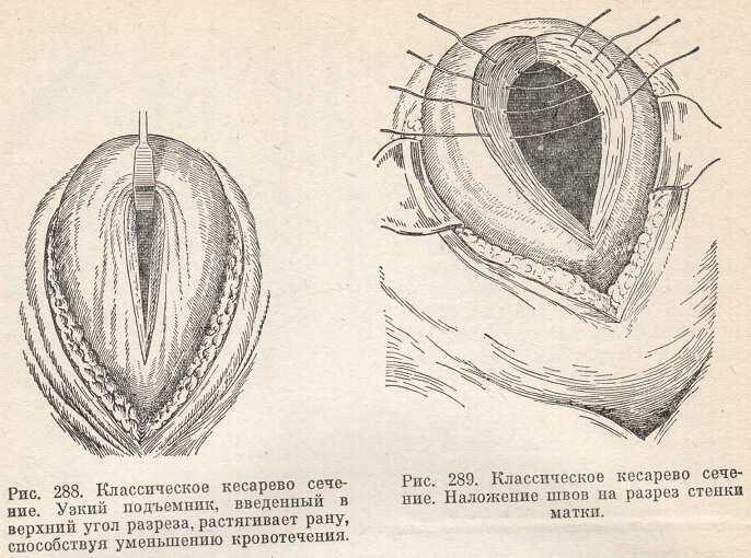 Кесарево сечение – показания, как проводится операция, недостатки и плюсы | аборт в спб