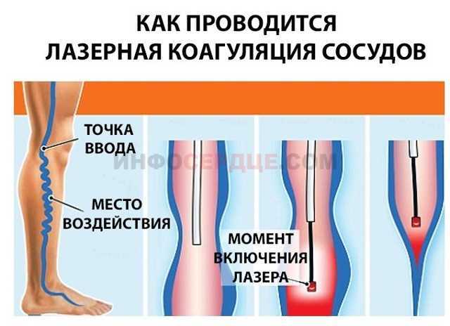 Хирургическое (классическое) лечение варикозной болезни - флебэктомия