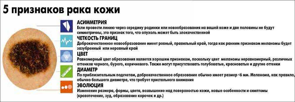 Меланома: диагностика и удаление