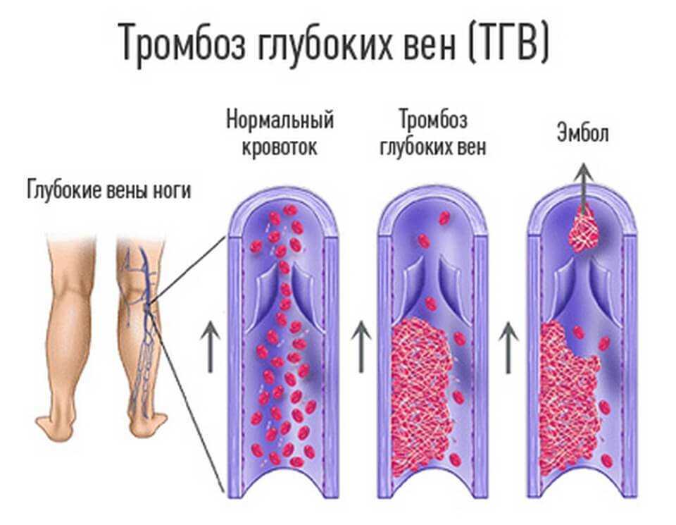 Тромбоз глубоких вен