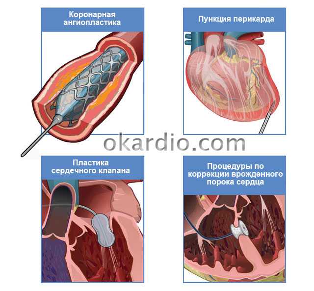 Коронарография