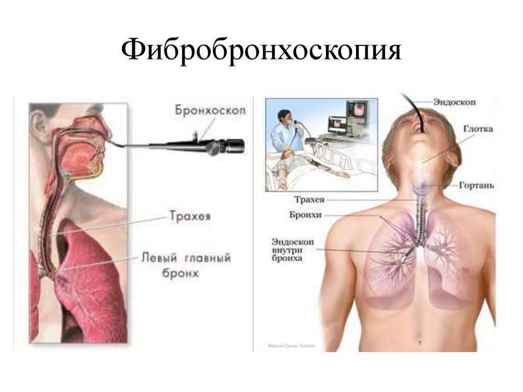Бронхоскопия — большая медицинская энциклопедия