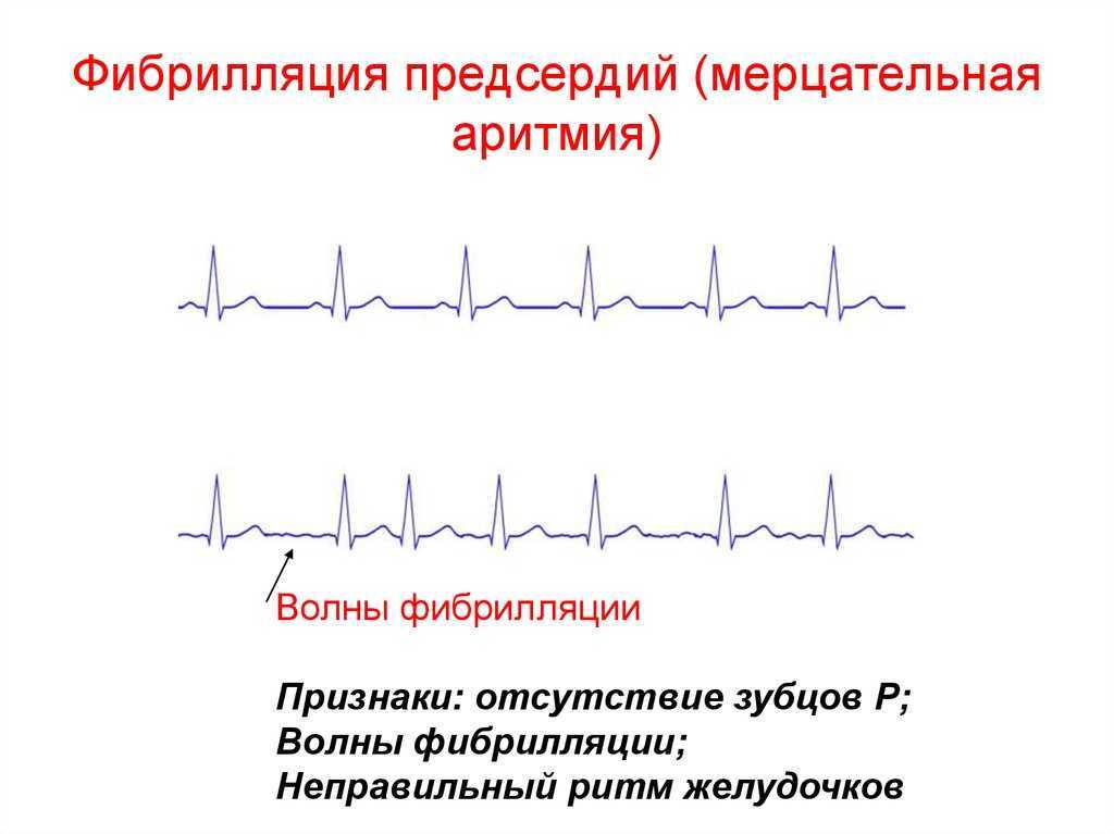 Мерцательная аритмия сердца