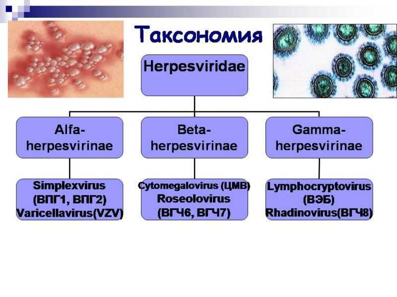 Постгерпетическая невралгия