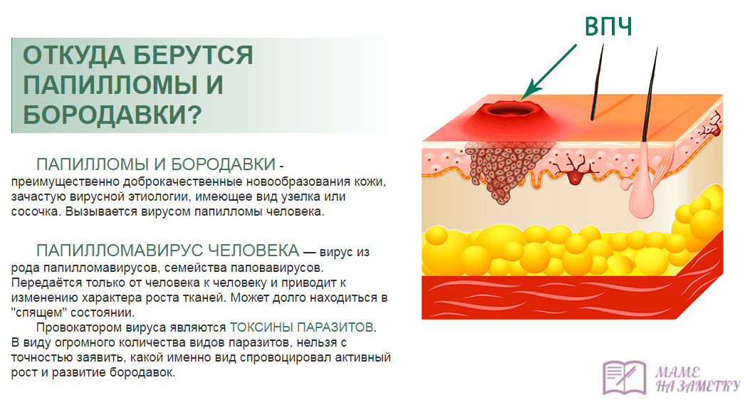 Папилломавирусная инфекция