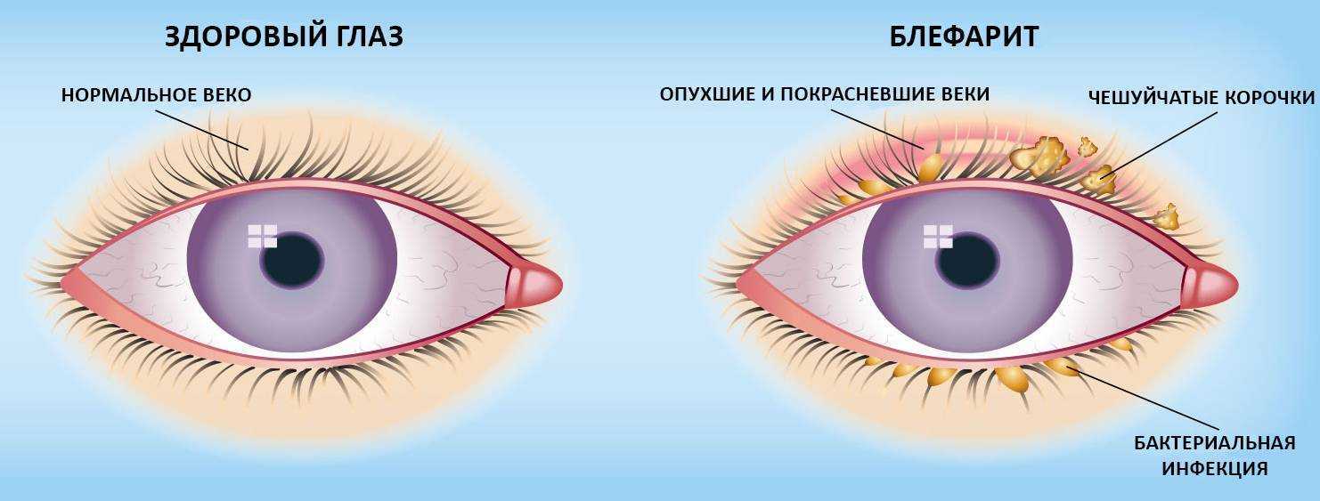 Блефариты, симптомы и лечение | santen