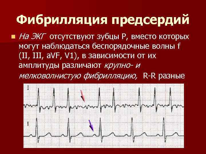 Нарушения сердечного ритма. виды, причины и опасность аритмий