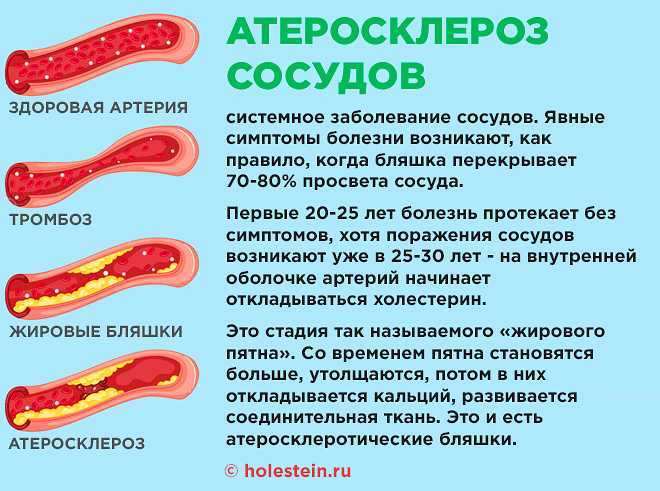 Атеросклероз