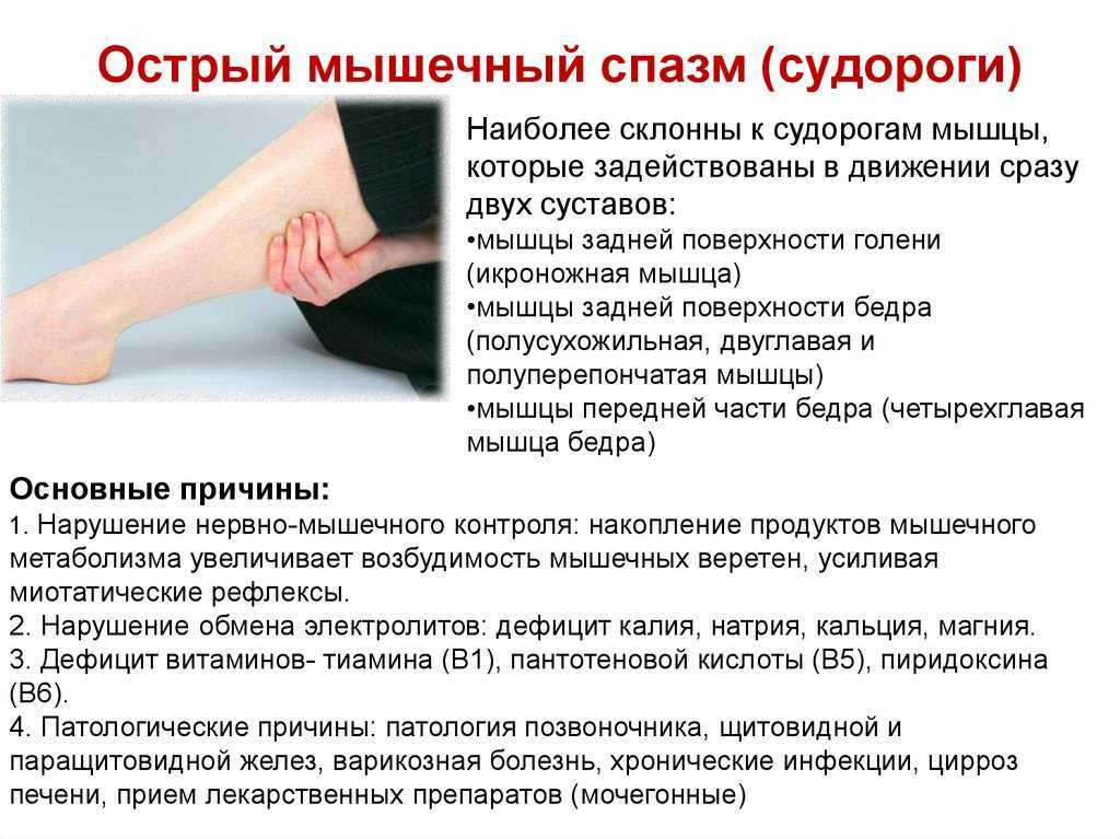 Судороги в ногах: причины, профилактика, что делать, как лечить