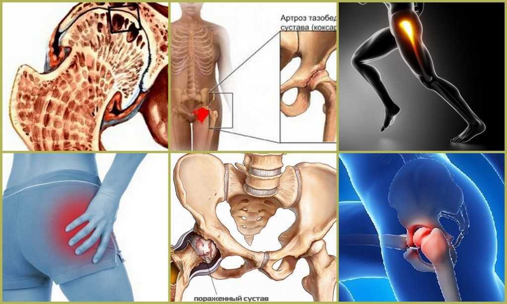 Упражнения для тазобедренного сустава в домашних условиях
