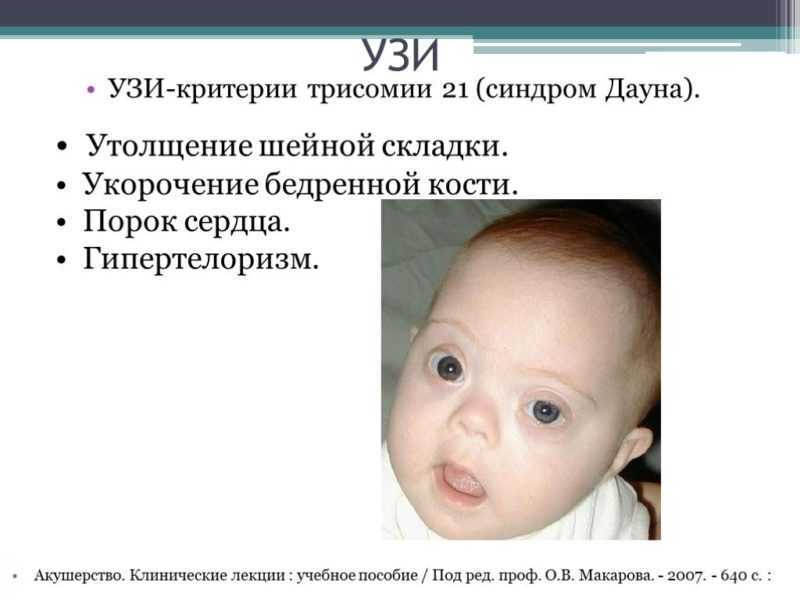 Синдром дауна - симптомы, риски, ранняя диагностика