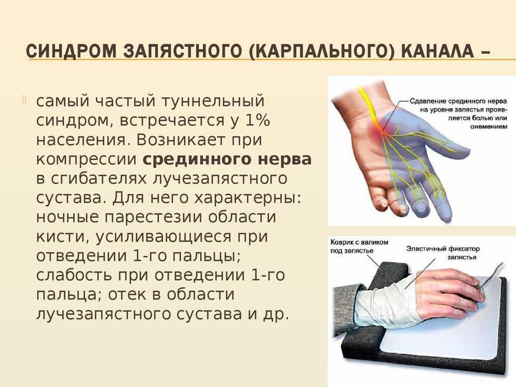Немеют пальцы рук: лечение синдрома запястного канала