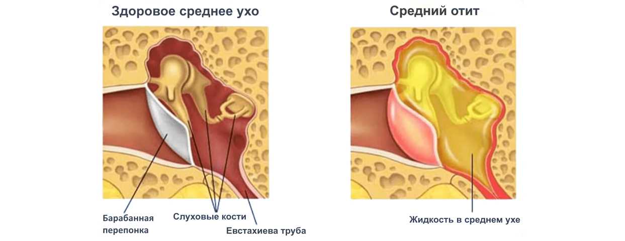 Отит: виды, симптомы, лечение