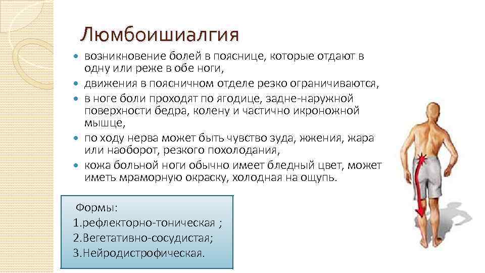 Радикулит