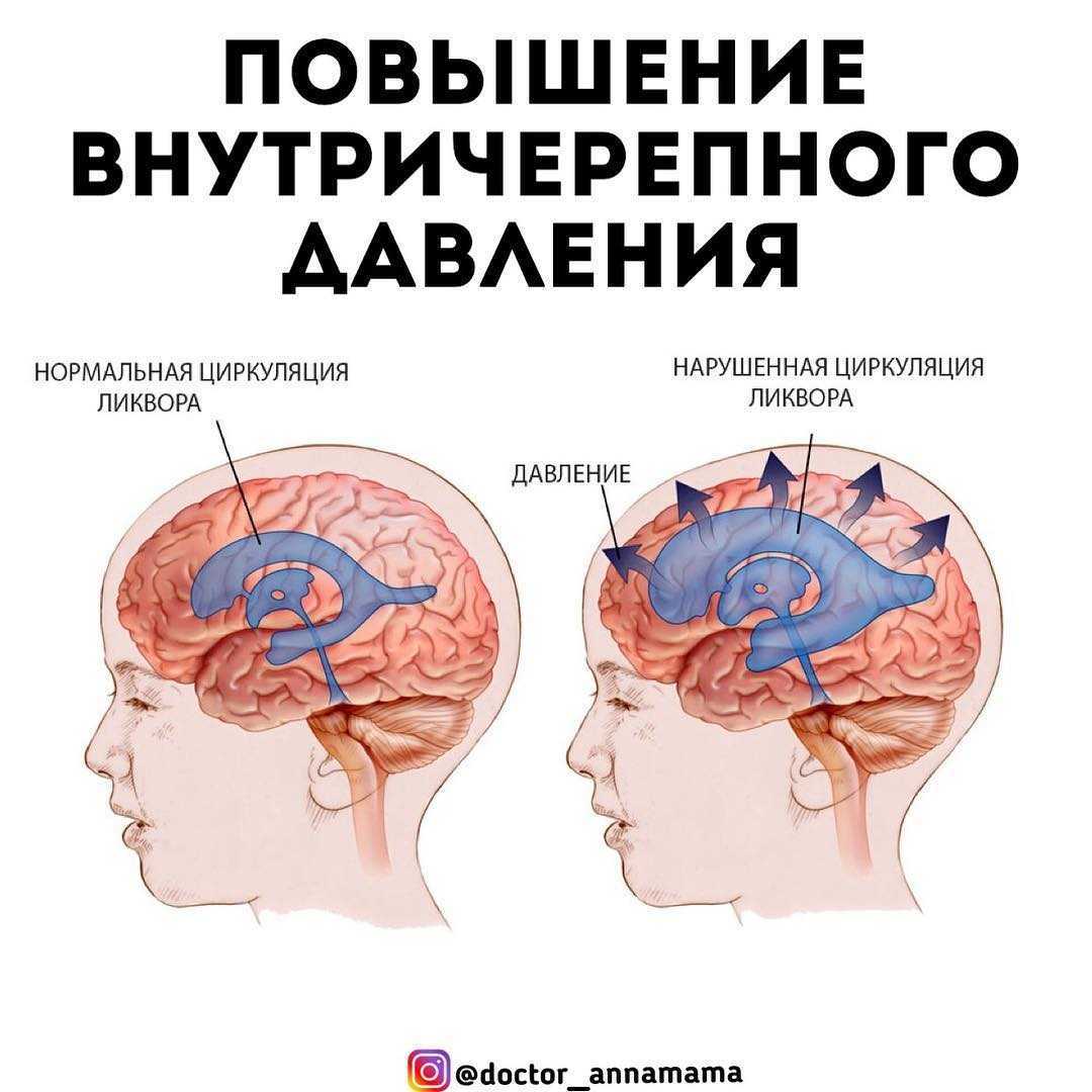 Это повышение давления спинномозговой жидкости, которая циркулирует в желудочках мозга, пространстве между мозгом и черепом, спинномозговом канале, данное состояние не является самостоятельной болезнью, оно лишь сопровождает другие патологии