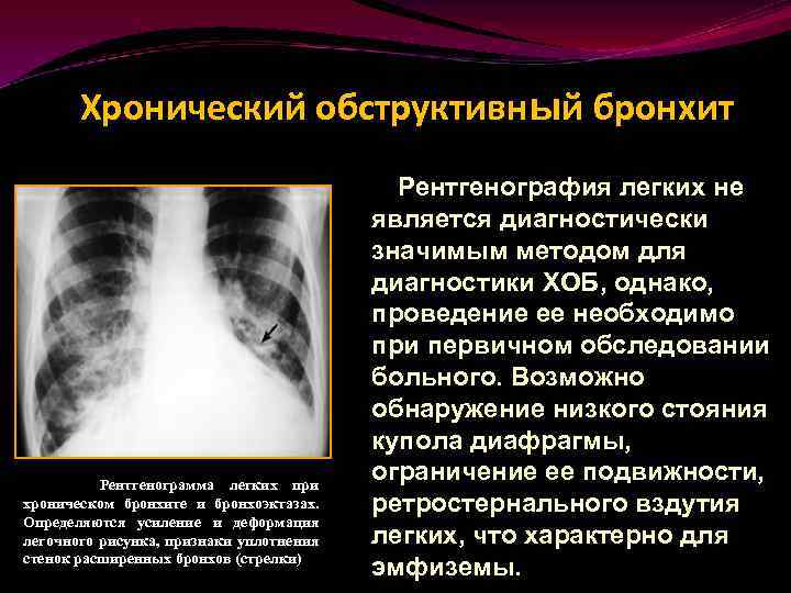 Саркоидоз легких: симптомы, лечение, степени, прогноз для жизни