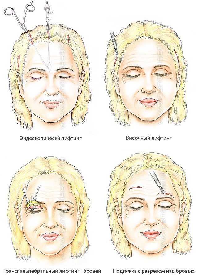 Эндоскопическая подтяжка бровей и лба с помощью устройства endotine forehead