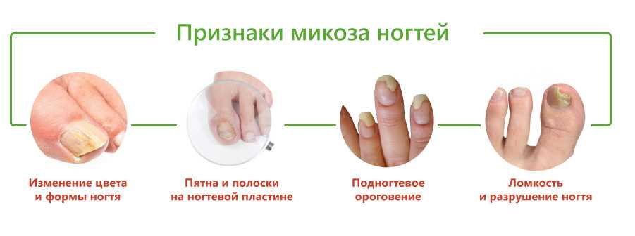 Стригущий лишай у человека. симптомы, причины, лечение для взрослых и детей :: polismed.com