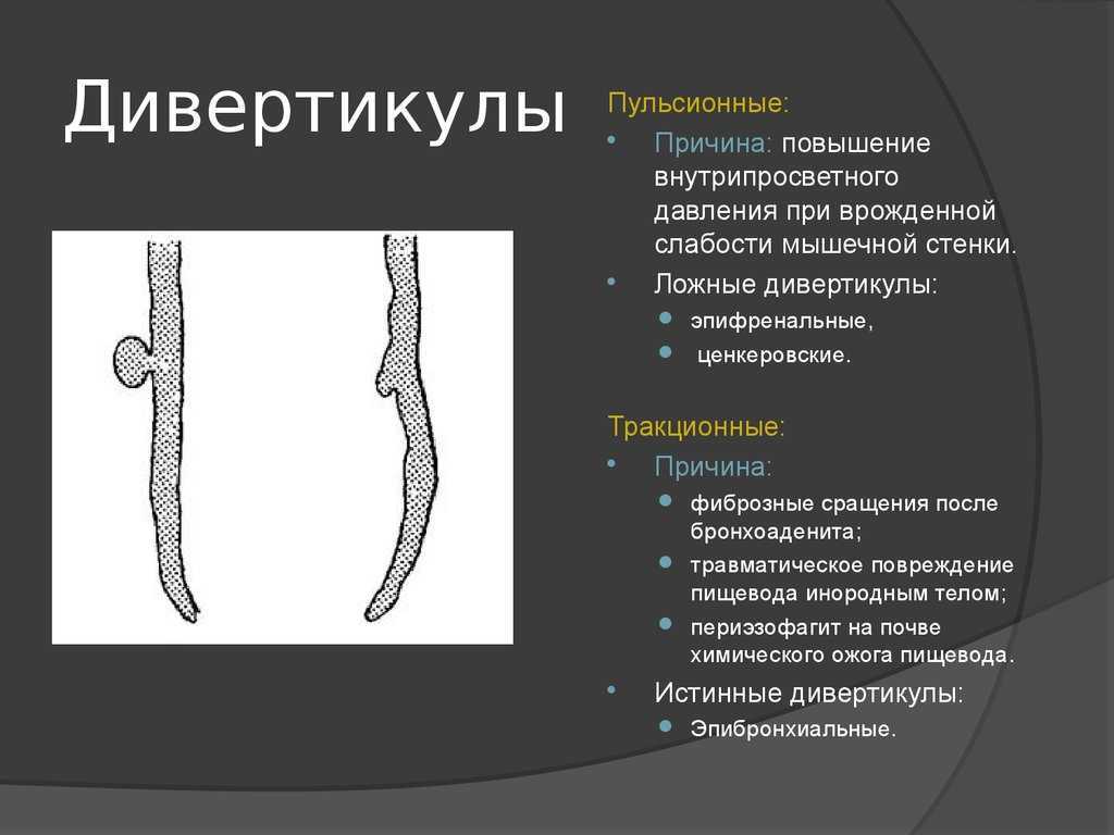 Дивертикулы толстой кишки