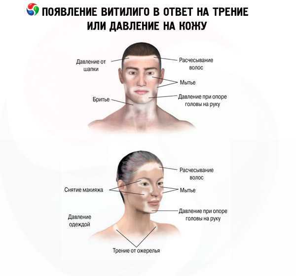 Пигментация после отпуска: как избавиться от пигментации, виды пигментных пятен - косметология доктора корчагиной