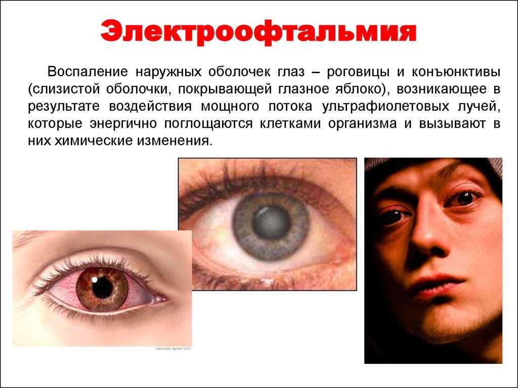 Что делать, если болят глаза от сварки?