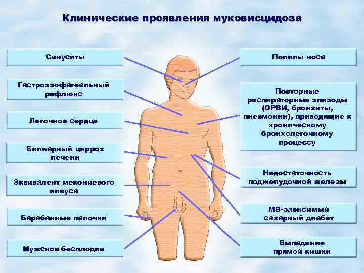 Синдром марфана