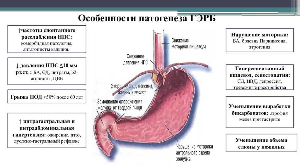 Рефлюкс эзофагит и изжога