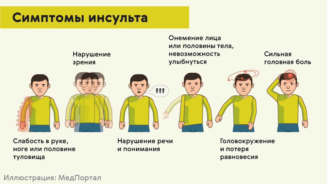 Инсульт: признаки, симптомы, лечение, причины