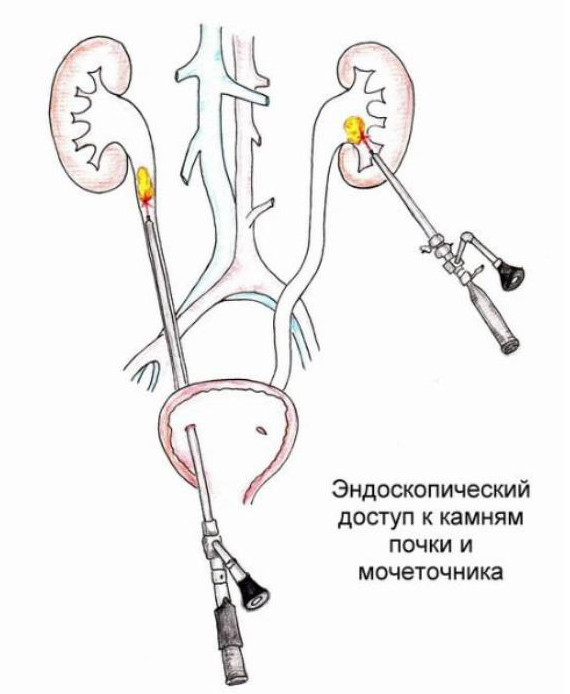 Удаление камней из мочеточника