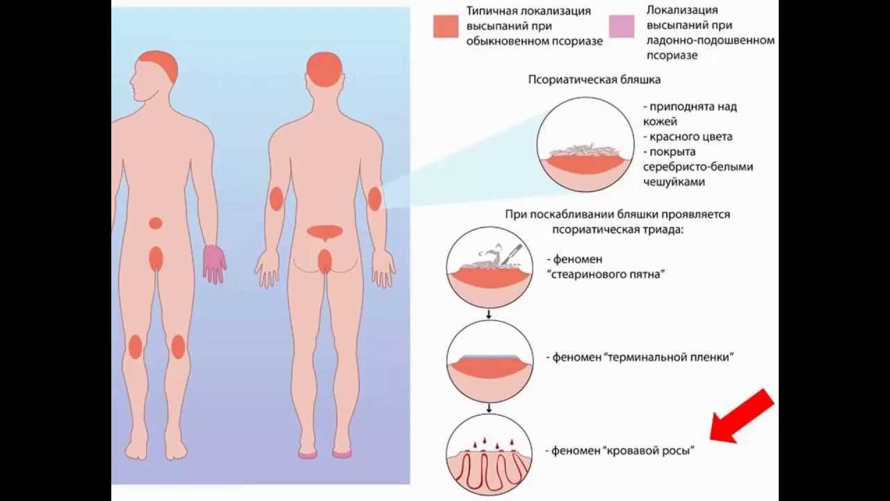 Псориаз – причины и лечение