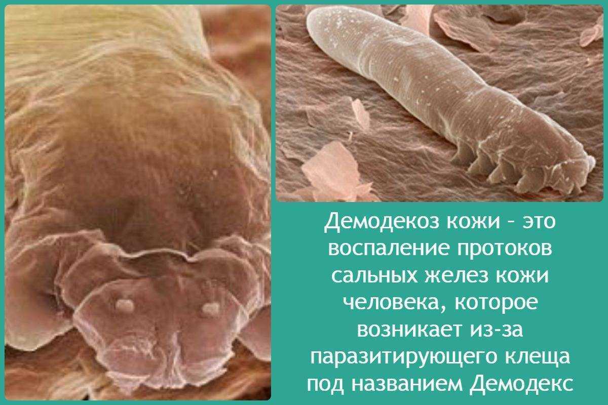 ? что такое демодекоз? ~?лечение демодекоза в киеве?