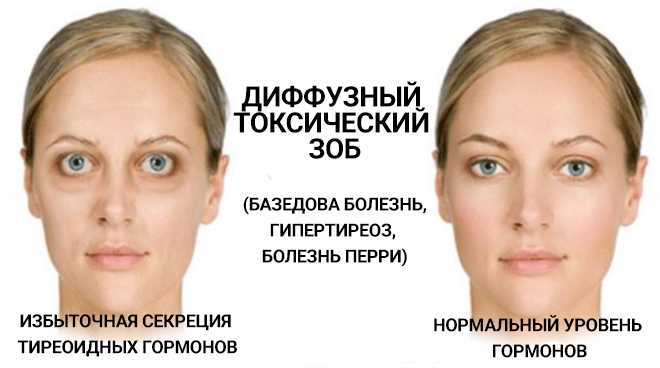 Тиреоидит : причины, симптомы, диагностика и лечение