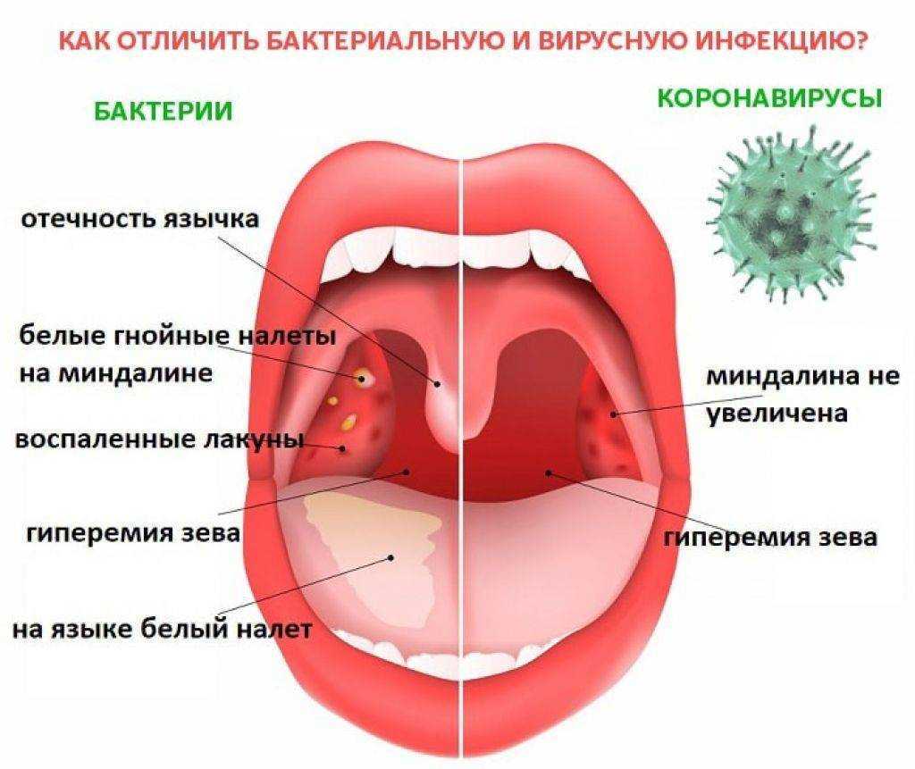 Гипертрофия небных миндалин!