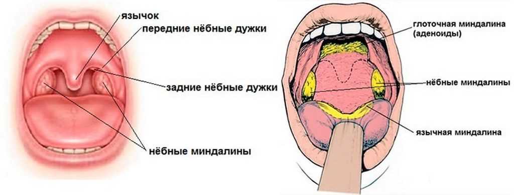 Хронический тонзиллит лечение