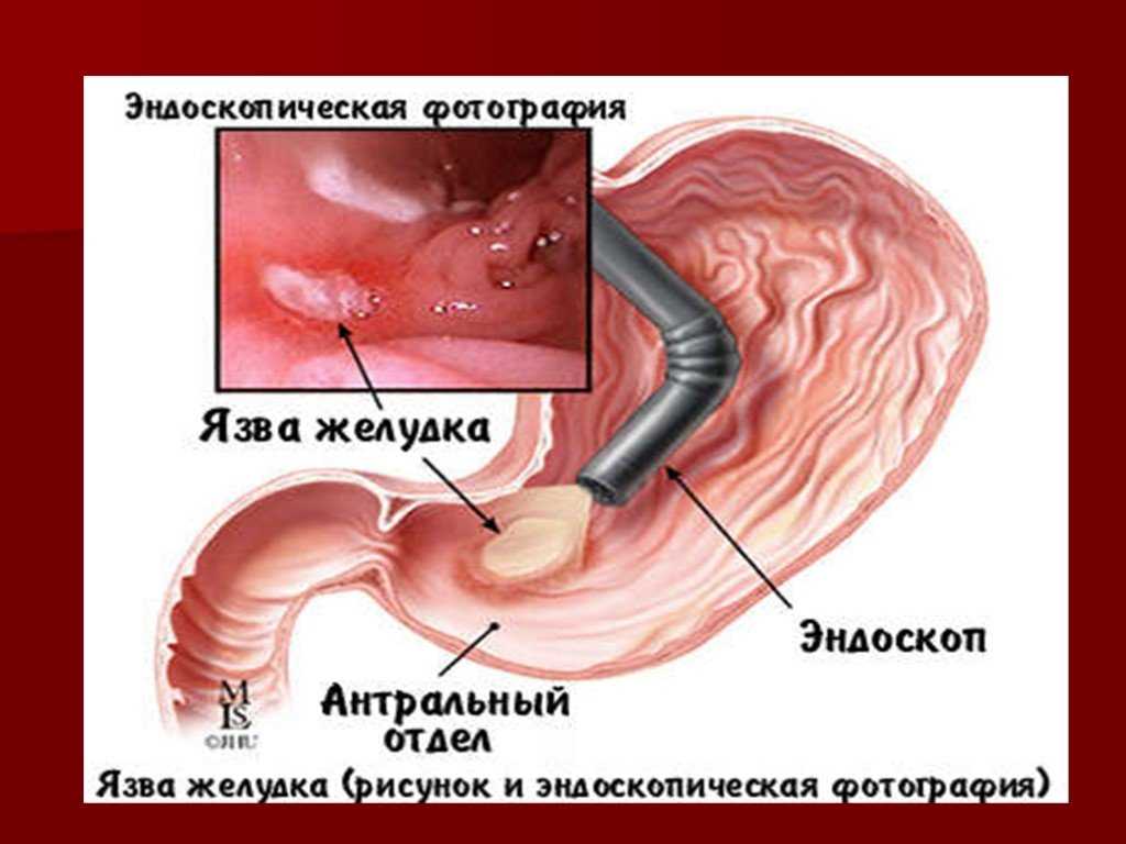 Язва желудка и двенадцатипёрстной кишки