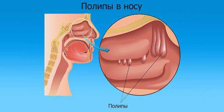 Полипы в носу