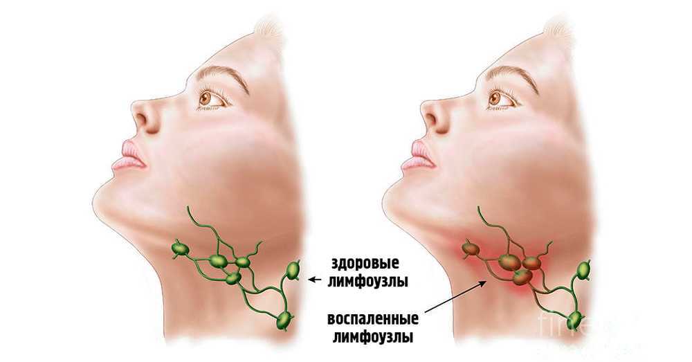 Увеличенные лимфатические узлы — лимфаденопатия | университетская клиника