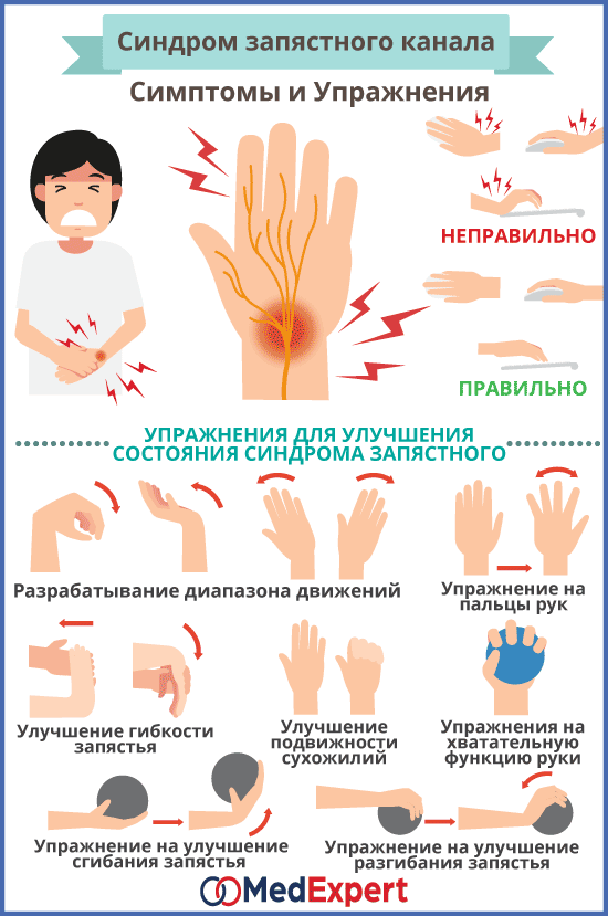 Туннельный синдром запястья: симптомы и лечение