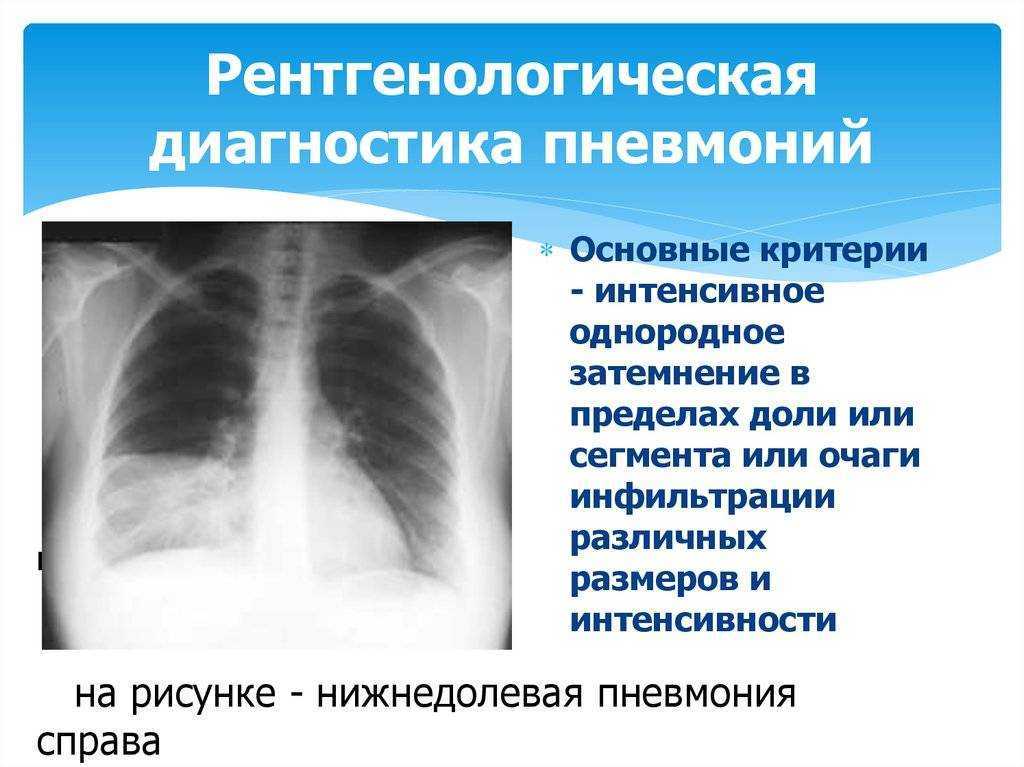 Рентген (рентгенография) органов грудной клетки обзорная — клиника «доктор рядом»