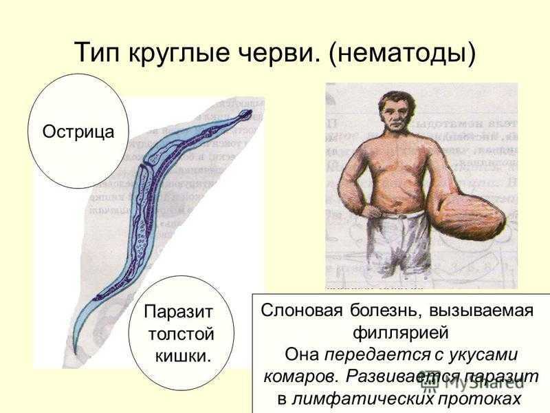 Филяриатоз лимфатический