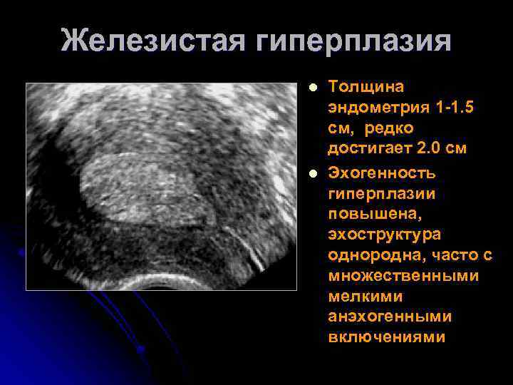 Пролиферативные заболевания эндометрия