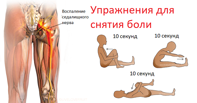 Радикулит