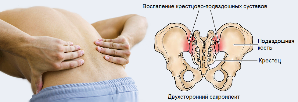 Крестцово-подвздошное сочленение – воспаление, симптомы, диагностика, методы лечения и профилактики